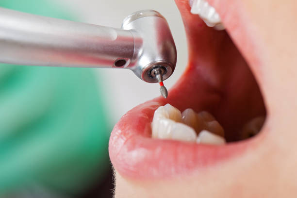 Best Knocked-Out Tooth (Avulsed Tooth) Treatment in West Lafayette, OH